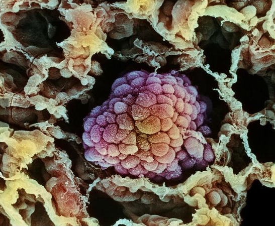 célula cancerígena