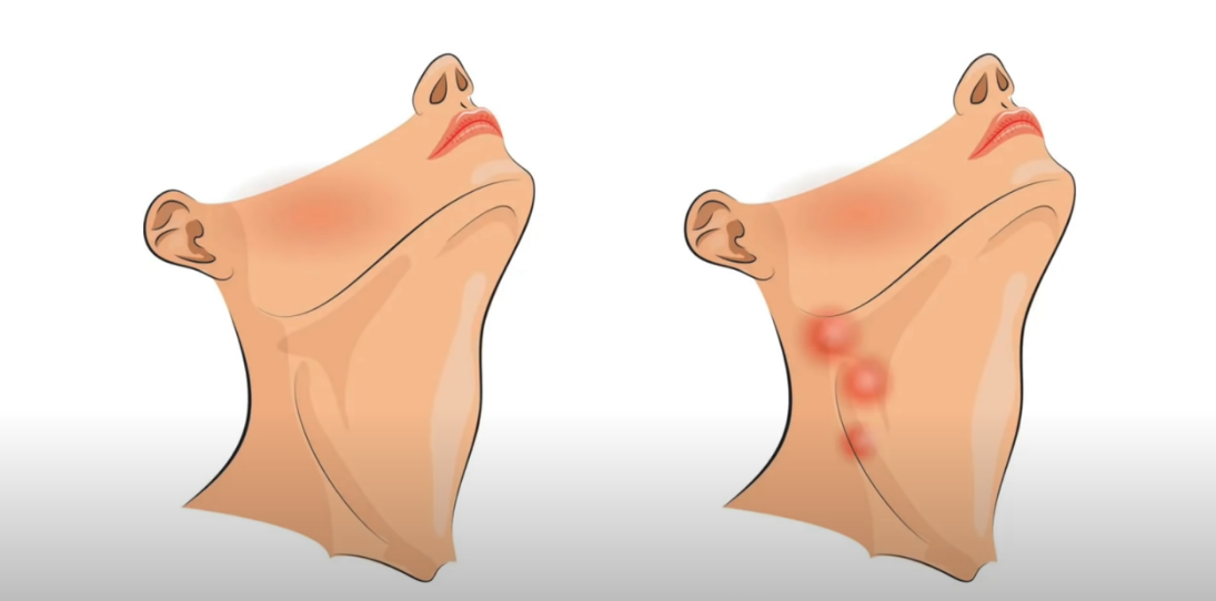 viruela-humana-viruela-del-mono-diferencias-ganglios