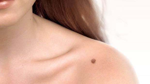 ¿Cómo identificar lunares peligrosos? Aprende la regla ABCDE