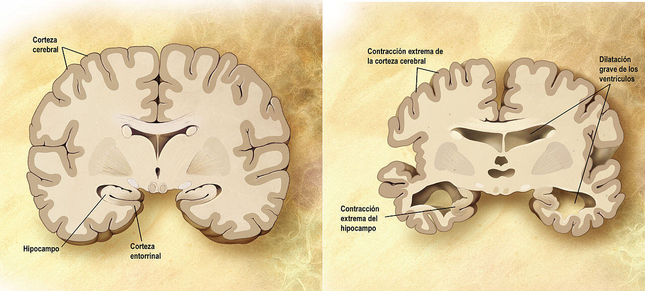 definición clínica alzheimer